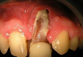 osteomyelitis na tandextractie