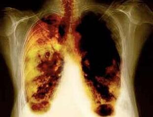 Longlaesies bij het gebruik van nicotine